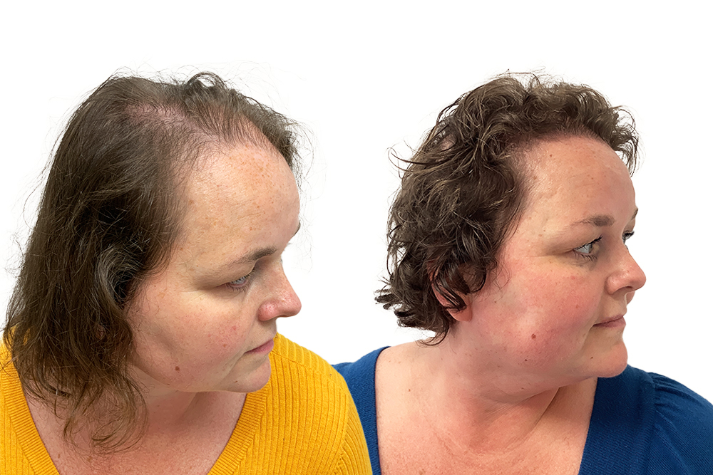 Hårtransplantation resultat