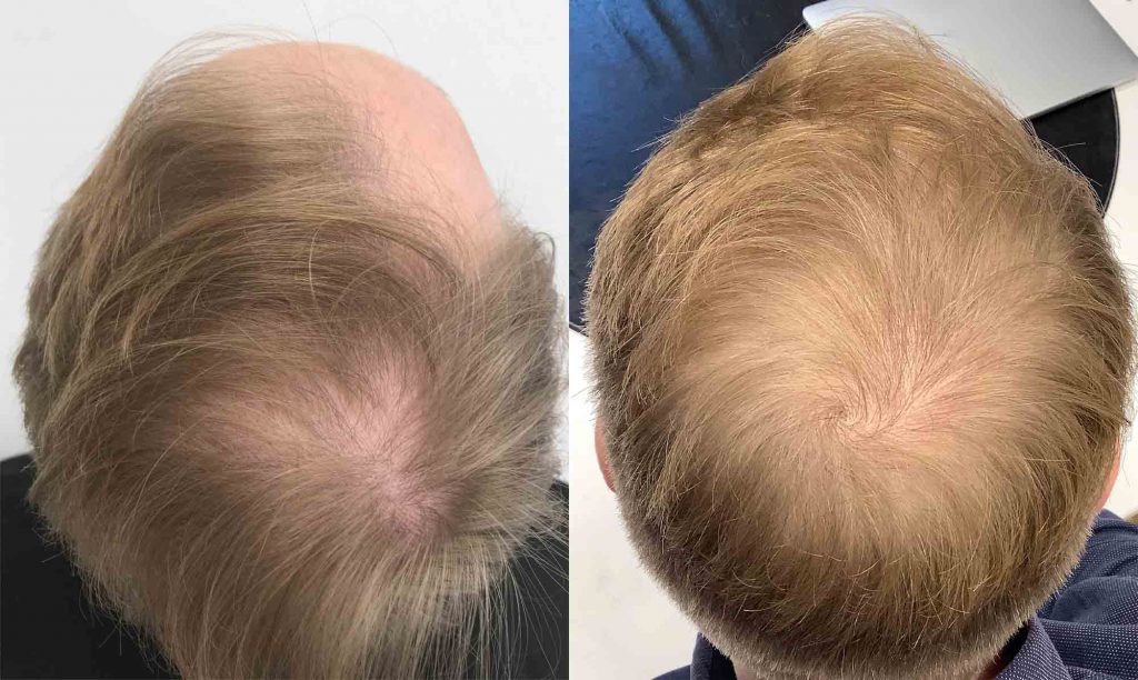 Evin's hair after three treatments with PRP