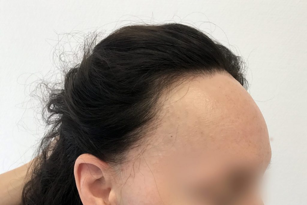 Female Frontal Fibros