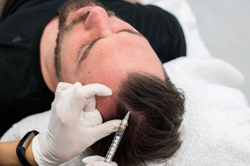 A man receives PRP and finasteride for hair loss
