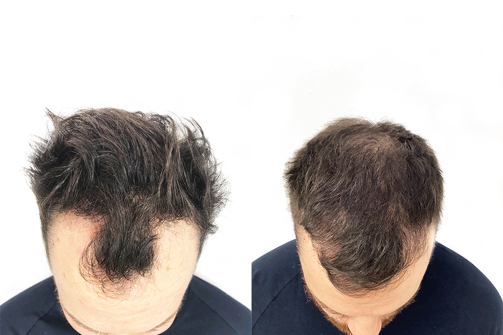 Bare seks måneder senere kunne vi se et meget lovende resultat med en jevnere hårfeste.