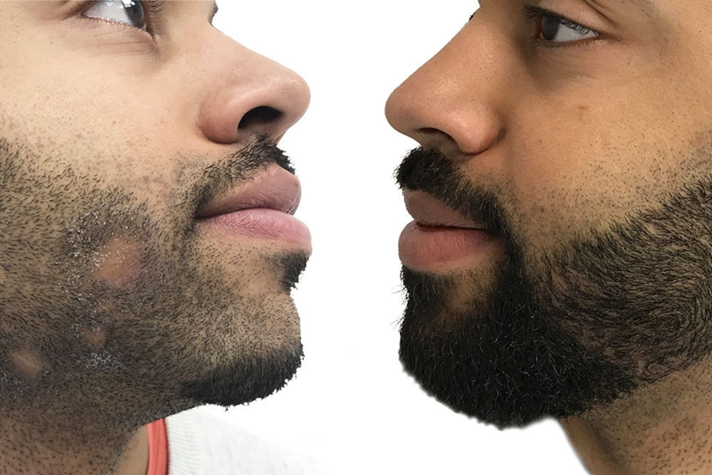 Beard transplant at Gabriel