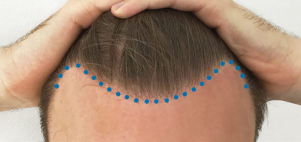 en mandlig hårgrænse