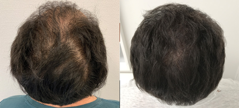 prp-behandling resultat