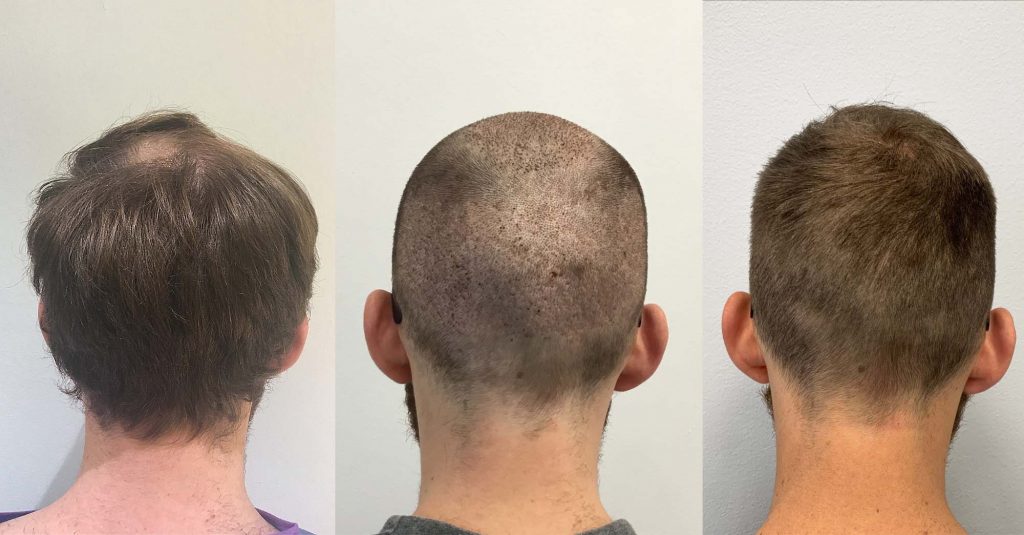 Før og etter bilde av Jonas sin hårtransplantasjon
