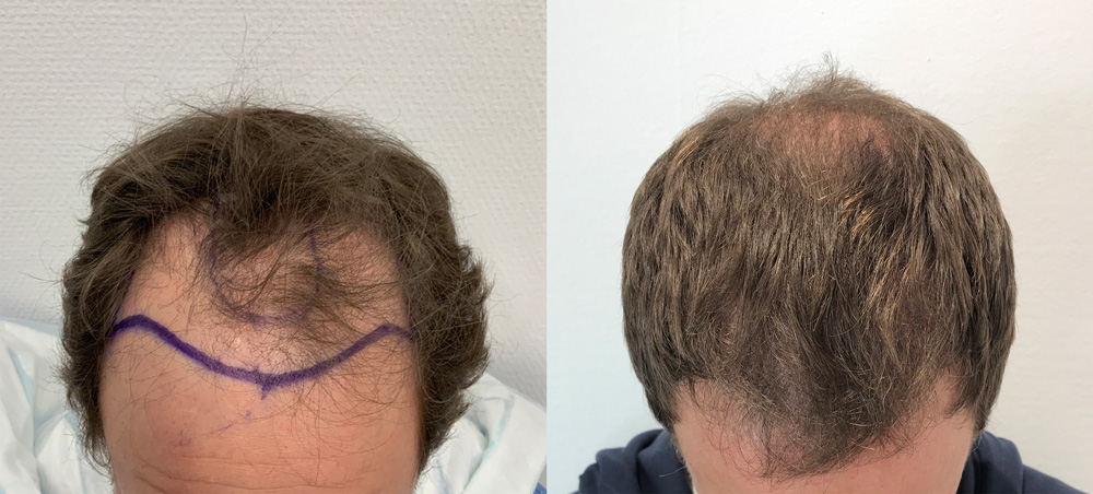 Hårtransplantation resultat