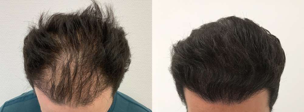 prp-behandling resultat