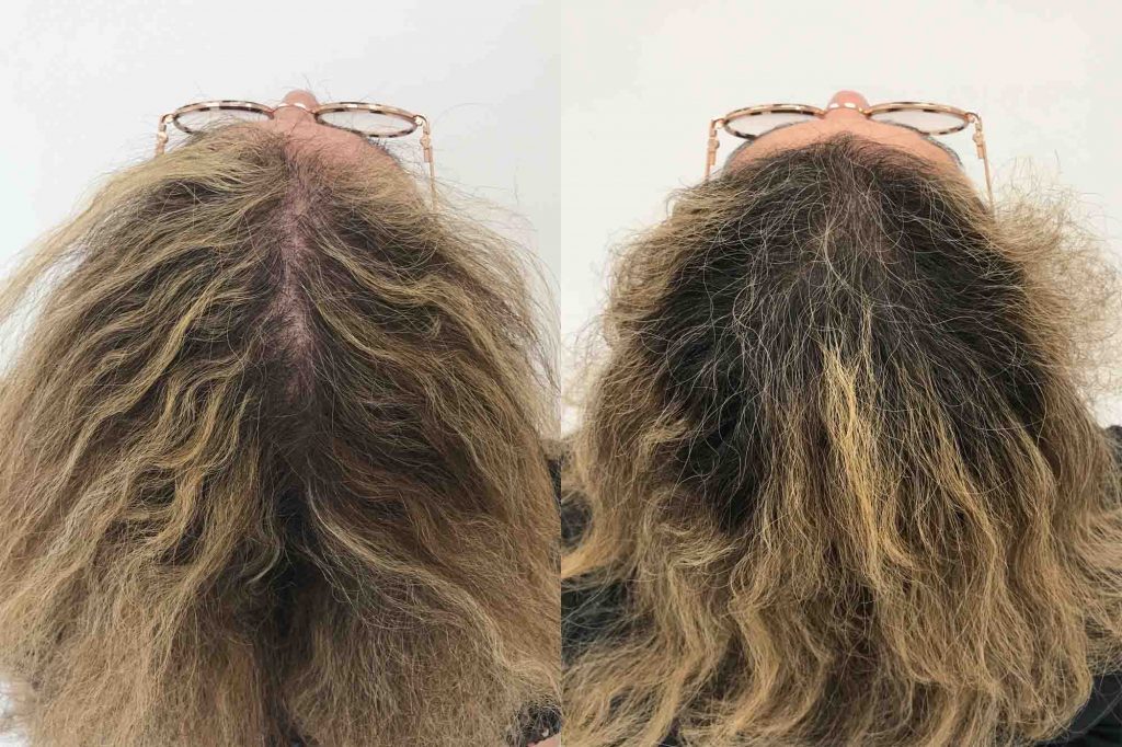 Madelenes resultater etter hennes PRP-behandling