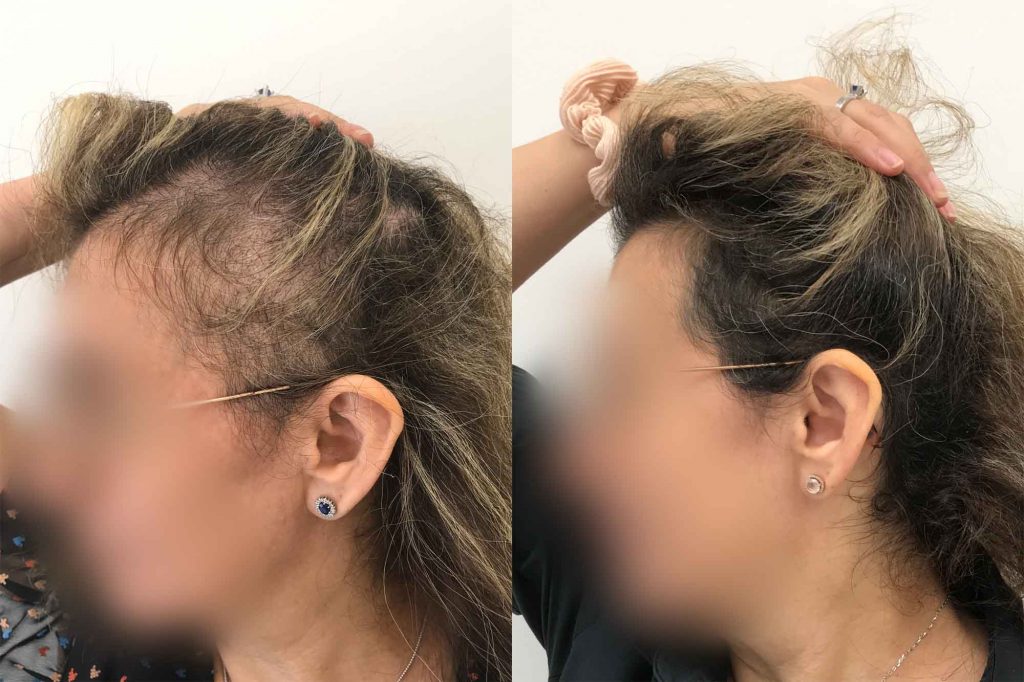 Madelene's results after her prp treatment