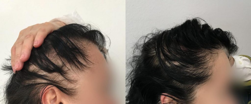 Results of Marianne's hair after PRP treatment