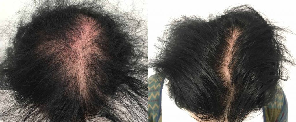 Results of Marianne's hair after PRP treatment