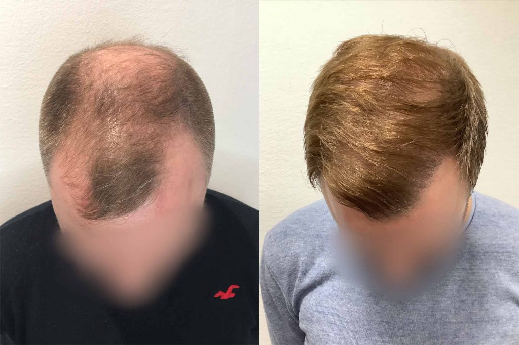 Martins hår ni måneder etter inngrepet.