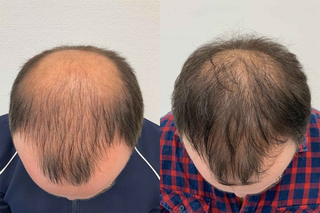 Hårtransplantation resultat