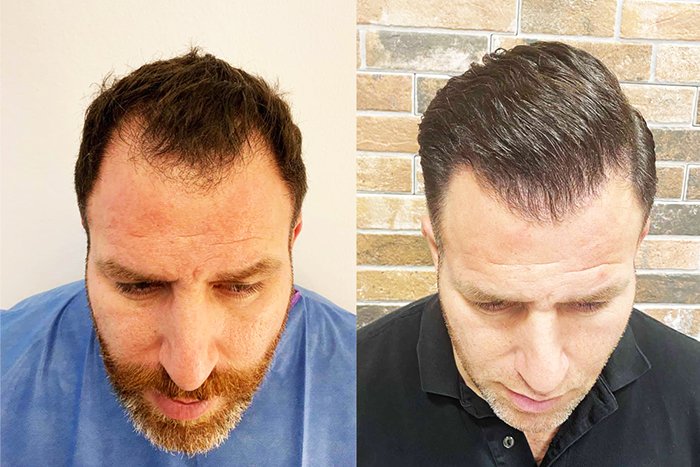 Hårtransplantation resultat