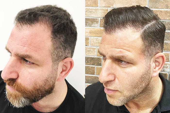 Hårtransplantation resultat