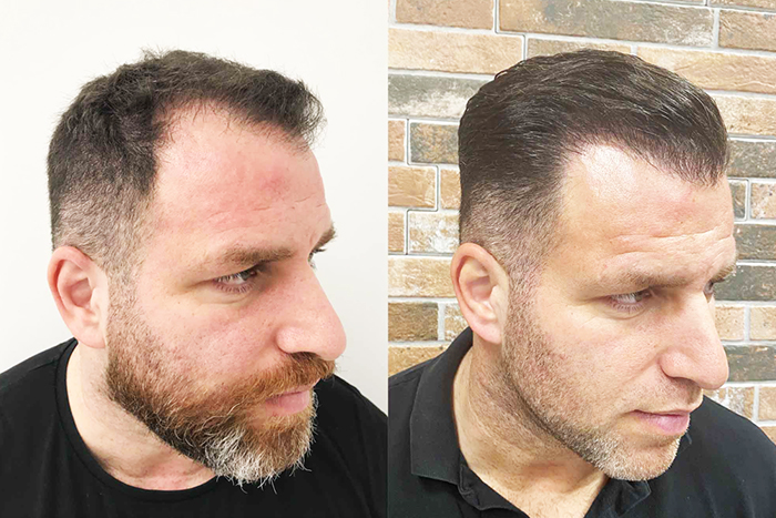 Hårtransplantation resultat