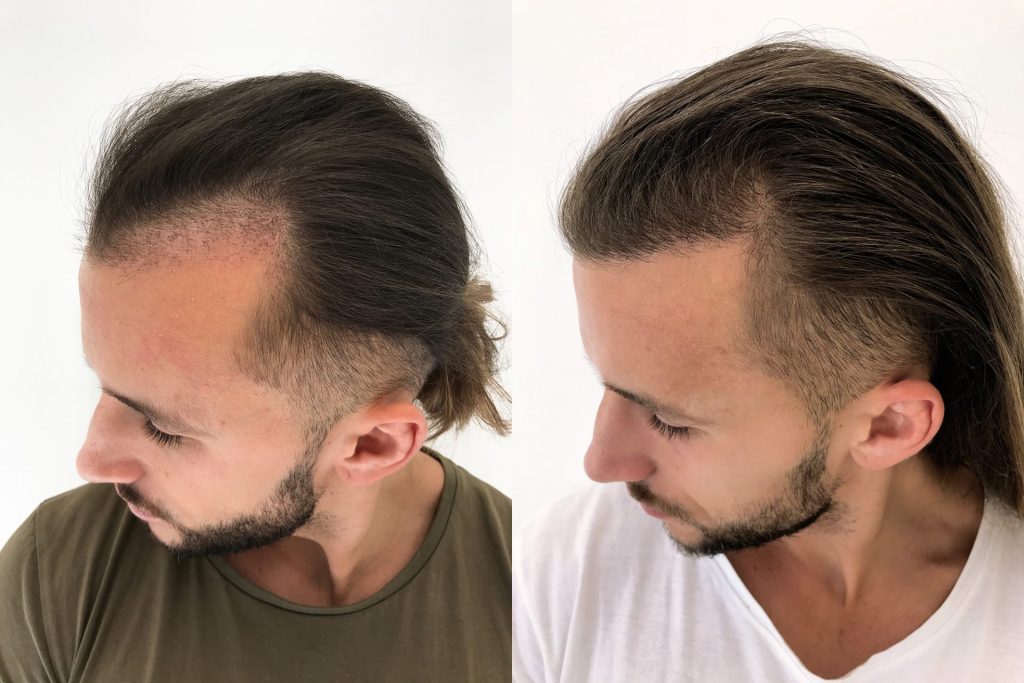 Hårtransplantation resultat