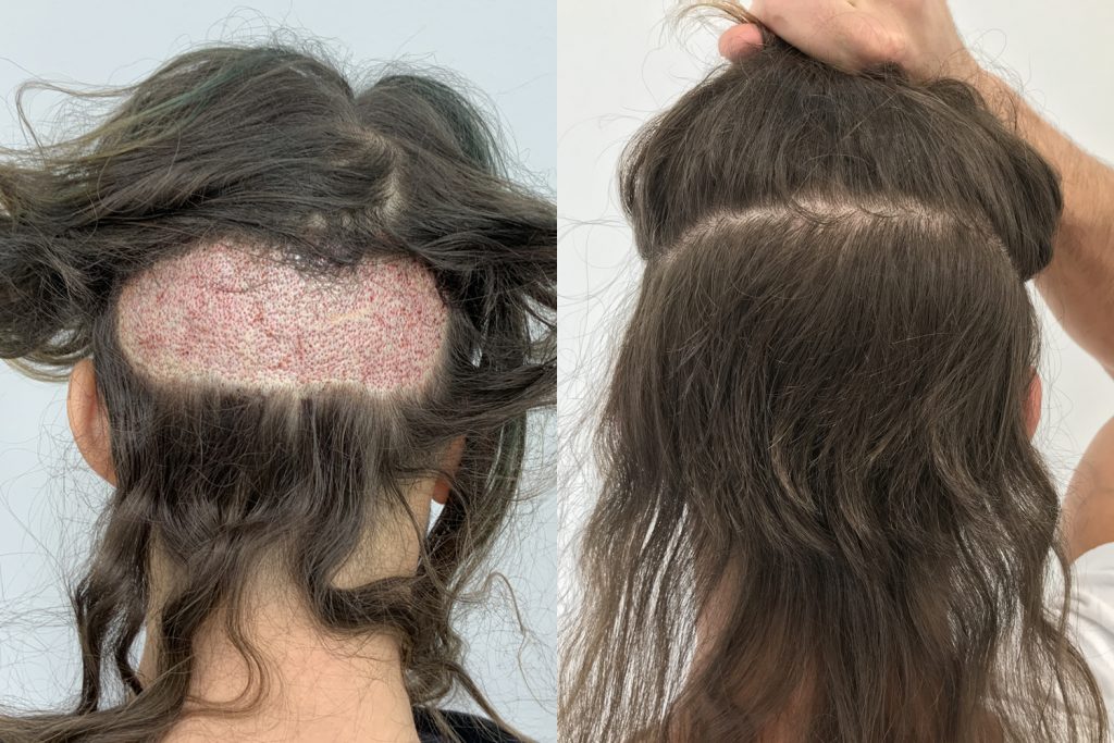 Hårtransplantation resultat