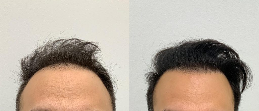 Max sine resultater etter hårtransplantasjonen