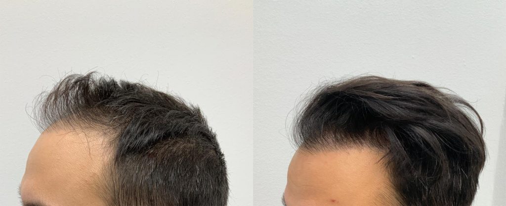 Max sine resultater etter hårtransplantasjonen