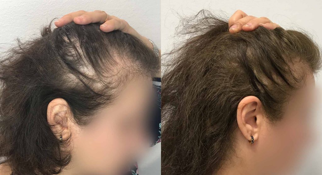 Nellie's hair after three treatments with PRP