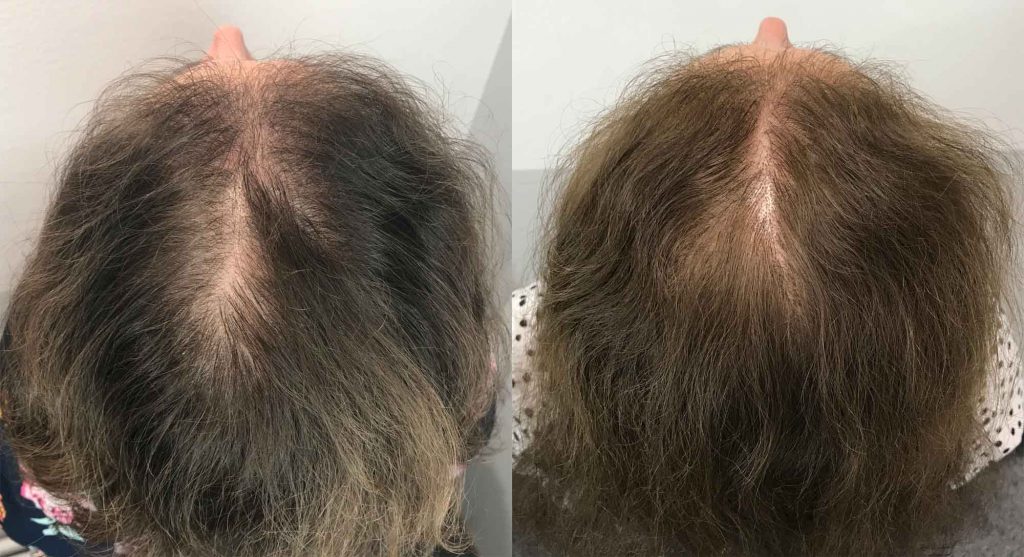 Nellies hår etter tre behandlinger med PRP