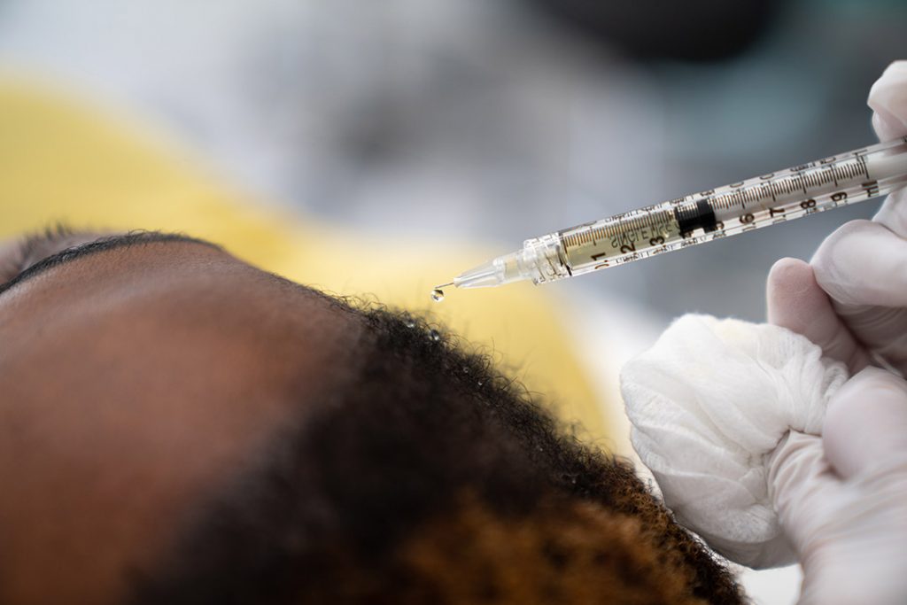 Sykepleier injiserer blodplasma med vekstfaktorer overfladisk inn i hodebunnen for å stimulere hårveksten