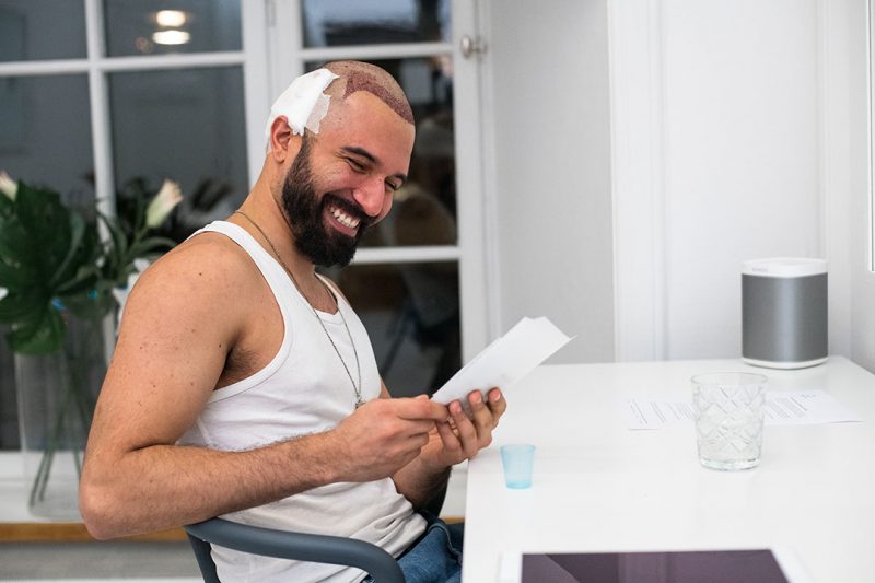 sean banan etter hårtransplantasjonen