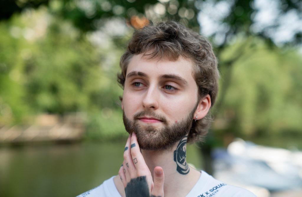 Lucas efter sin Skäggtransplantation