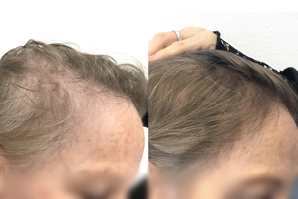 Sofia's hair before and after her 3 PRP treatments