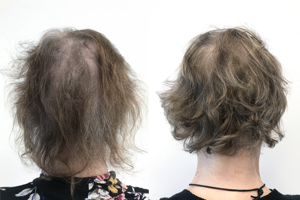 Sofias hår før og etter hennes 3 PRP-behandlinger