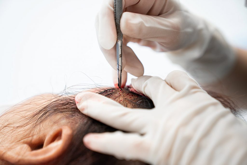 någon utför Transplantation med FUE-tekniken