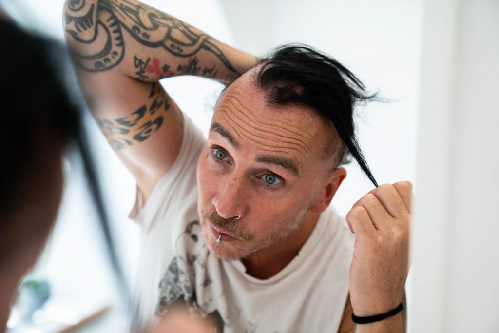 A man with alopecia areata looks in the mirror