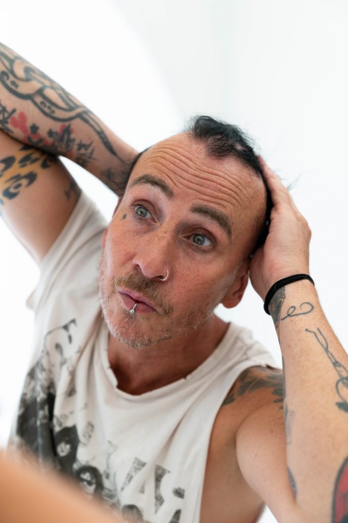 A man with alopecia areata looks in the mirror