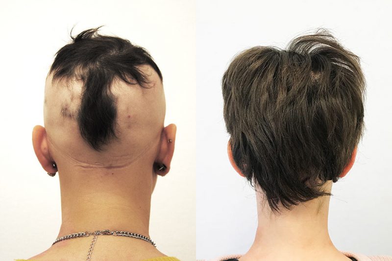 en kvinde med alopecia totalis