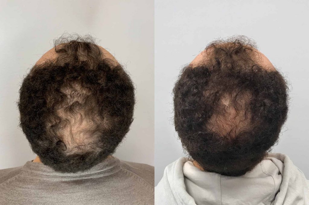 Abbe's hair after 3 PRP treatments