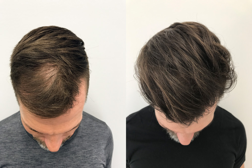 Hårtransplantation resultat