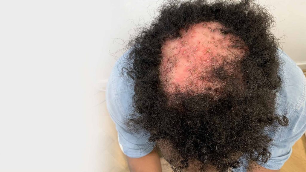 En mand med follicilitis decalvans