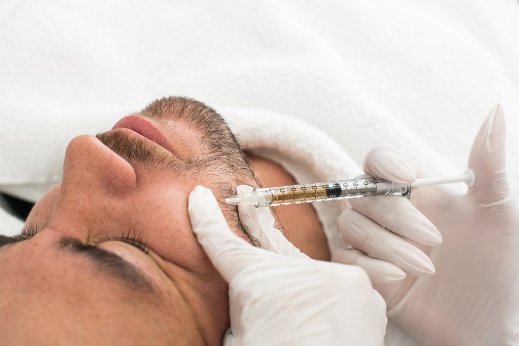 en man genomgår prp för skägget