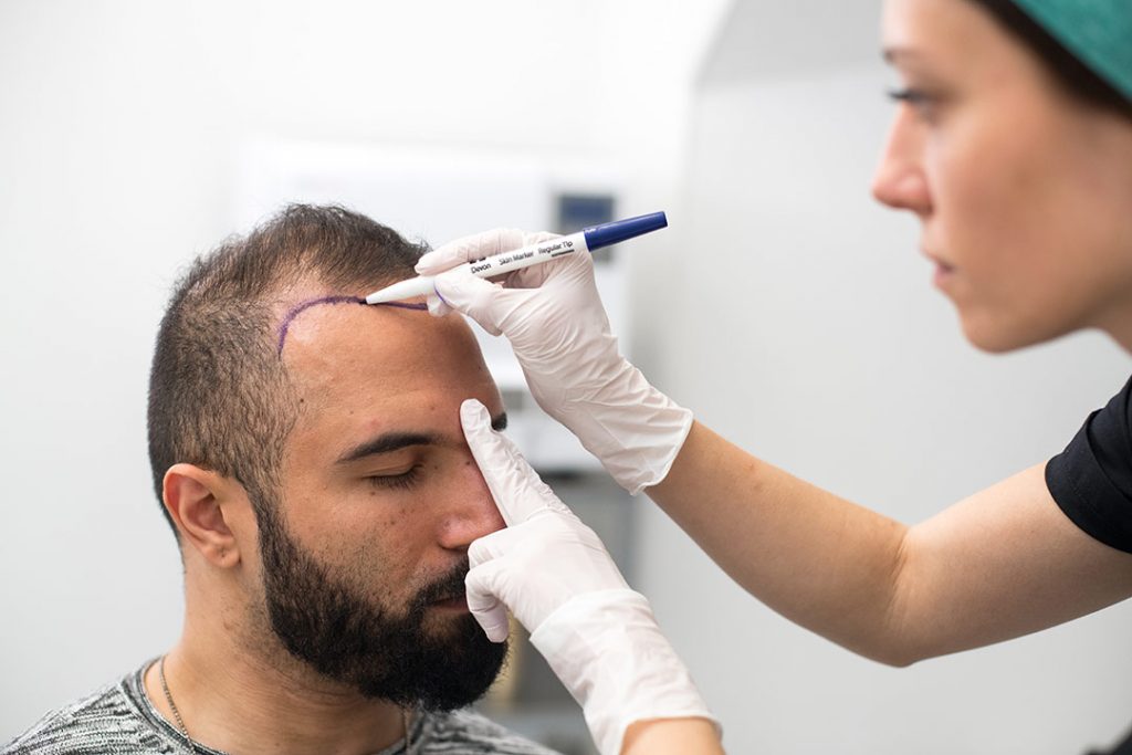 en mand får tegnet sin hårgrænse