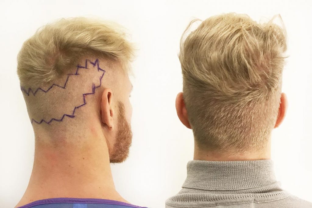 et donasjonsområde før og etter 12 måneder