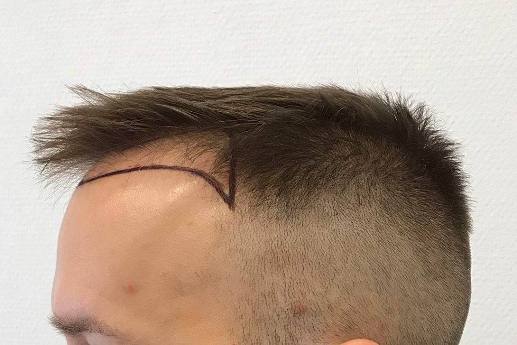 Adrian får tegnet en ny hårgrænse