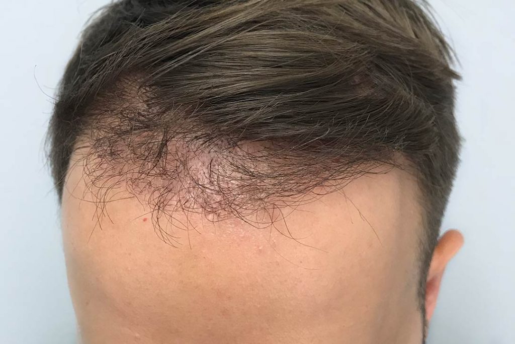 after a hair transplant