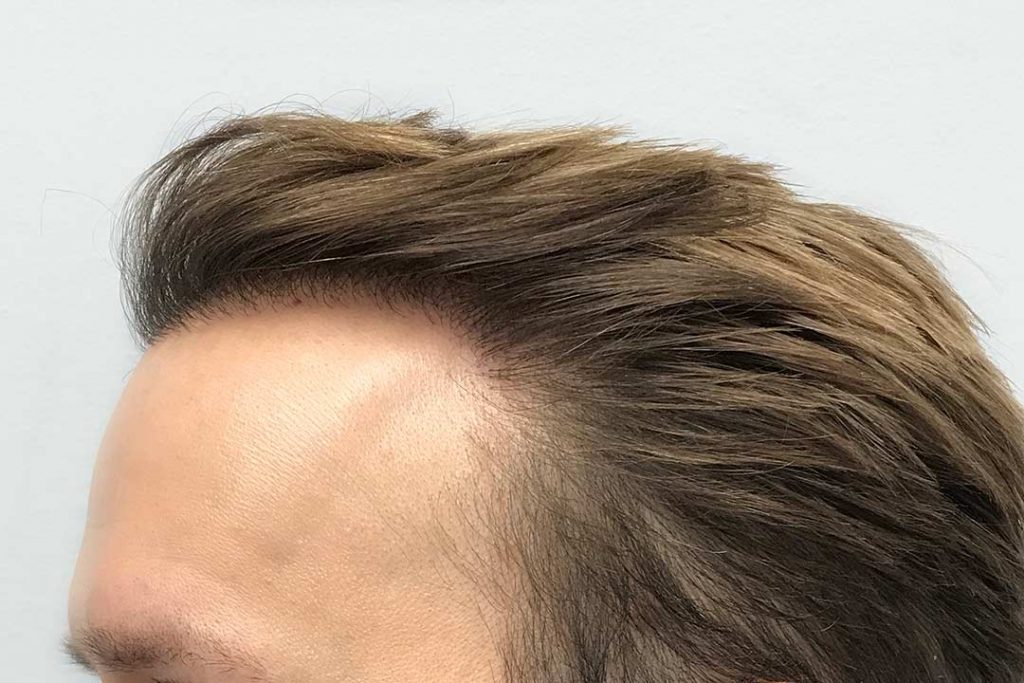 a man 6 months after hair transplant