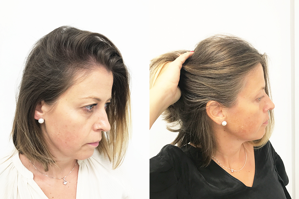 Amra after 3 treatments