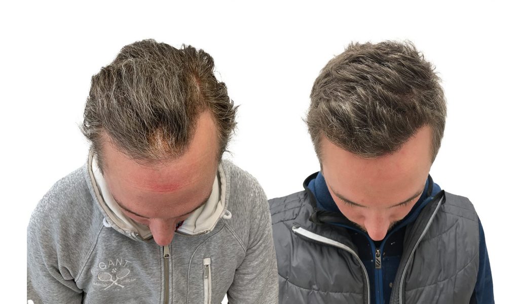 Carl 12 måneder etter inngrepet