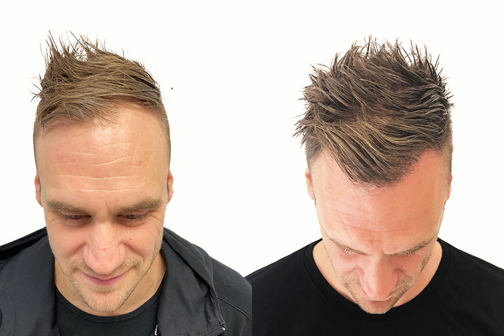 Christer 12 måneder etter transplantasjonen