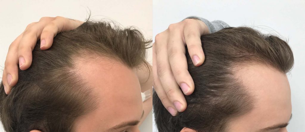 Franz before and after 3 treatments