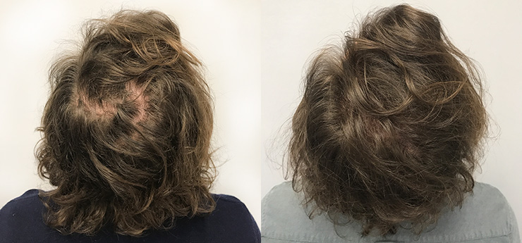 johan after 3 prp treatments