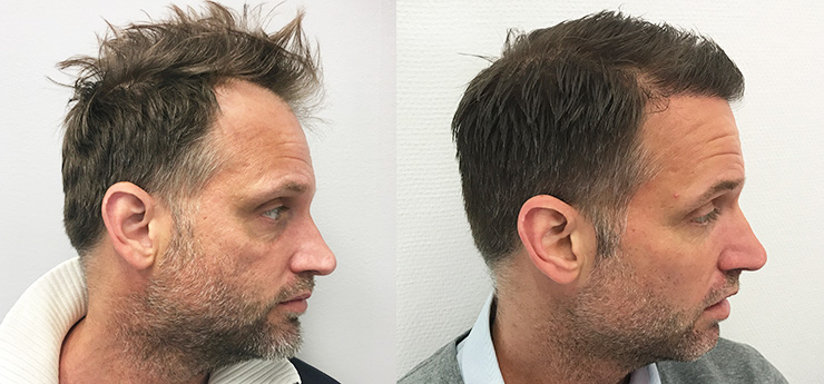 Micke før og etter hårtransplantasjonen